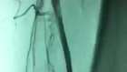 Peripheric Stent bacak damari Stent - YouTube