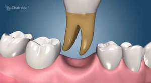 Köprü diş tedavisindeki 3 yöntem