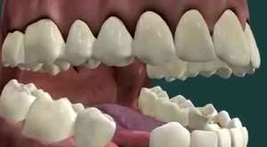 Köprü diş tedavisindeki 3 yöntem