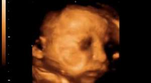 38 Haftalık Bebeğin Ultrason Görüntüsü