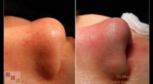 Burun Ucu Estetiği - Burun Ucu Kaldırma Öncesi ve Sonrası (Nose Tip Plasty – Nose Tip Lifting in İstanbul Turkey)