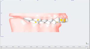Clearfix Şeffaf Plak 3D Simülasyon 