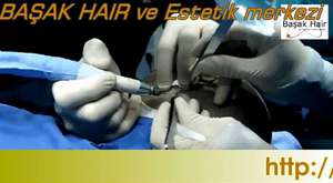 Haartransplantation in Istanbul