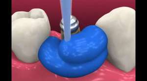 Yeni implant diş yapım video - 2015 Diş İmplantı Fiyatları 