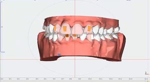 Clearfix Tedavi Simülasyonu - Diastema (Dişler Arası Boşluk) 