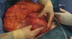 Karın Germe ve İnsizyonel Herni (Kesi Fıtığı) Ameliyatı