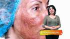 Kimyasal Peeling