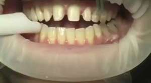 Diş Fırçalama Video