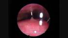 Uyku Endoskopisi - Küçük Dil Yumuşak ve Yumuşak Damak Bölgesinde Kapanma 