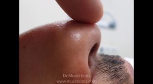 Burun Ucu Estetiği - Burun Ucu Kaldırma Öncesi ve Sonrası (Nose Tip Plasty – Nose Tip Lifting in İstanbul Turkey)