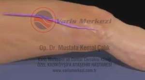 Laser therapy of spider veins