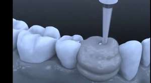 Lingual Ortodonti Diş teli takılması