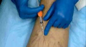 Laser therapy of spider veins