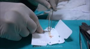 Burun Estetiği Ameliyatı - Kıkırdak Macunu Hazırlanması ve Deri Altına Yerleştirilmesi 