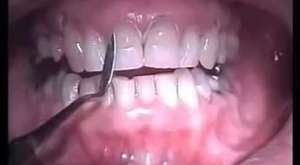 Lingual Ortodonti Diş teli takılması