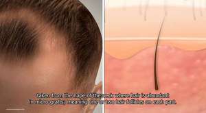 How Does a Hair Transplant Work