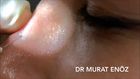 Burun Dolgusu Uygulaması - 4K Makro Çekim (Non-surgical Nose Job With Hyaluronic Acid Filler - 4K Macro Video) 