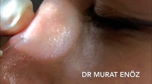 Cold Sterilized Serum and Ice Application On The Nose During Nose Aesthetic Surgery