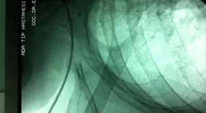 aort koarktasyonu 