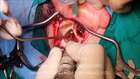 Mastoidektomi Ameliyati Videosu (Mastoidectomy Operation) 