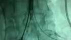 aort anevrizması 