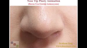 Burun Dolgusu Uygulaması - 4K Makro Çekim (Non-surgical Nose Job With Hyaluronic Acid Filler - 4K Macro Video) 