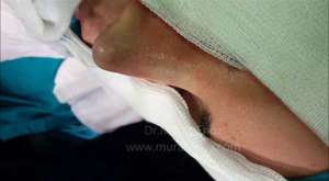 Kaburga Kıkırdağı İle Revizyon Burun Estetiği Ameliyatı (Revision Rhinoplasty With Cadaveric Rib Cartilage)