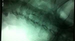 karotis stent 