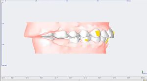 Clearfix Tedavi Simülasyonu - Diastema (Dişler Arası Boşluk) 