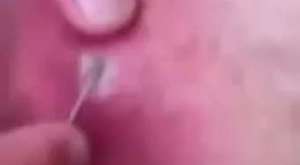 5 Worst Ear Bugs Ever! (Popping & Removal) 