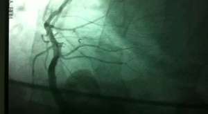 Peripheric Stent bacak damari Stent - YouTube